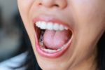 composite vs amalgam fillings in calgary which is better for your teeth