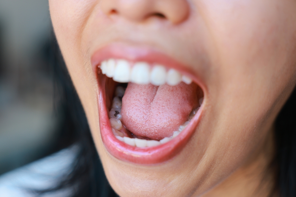 composite vs amalgam fillings in calgary which is better for your teeth