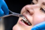 whitening for braces gentle and effective teeth whitening
